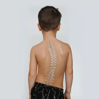 Σκολίωση σε παιδιά: Τρόποι αντιμετώπισης